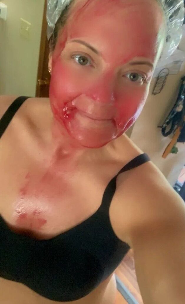 Real-life application of AHA 30% + BHA 2% peeling solution red mask during at-home chemical exfoliation treatment