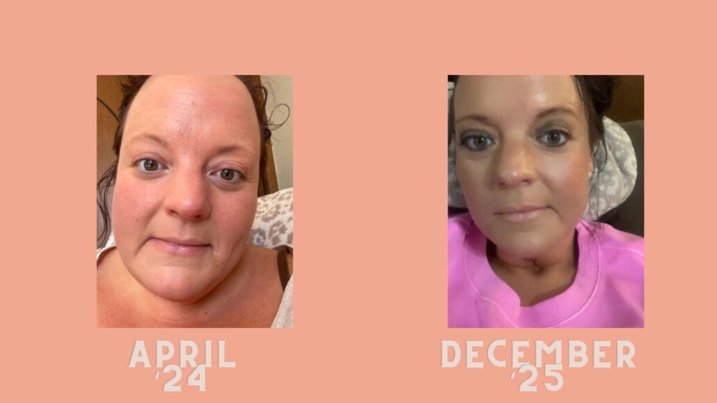 Side-by-side comparison showing a woman’s face before and after her tirzepatide journey, labeled April 2024 and December 2025